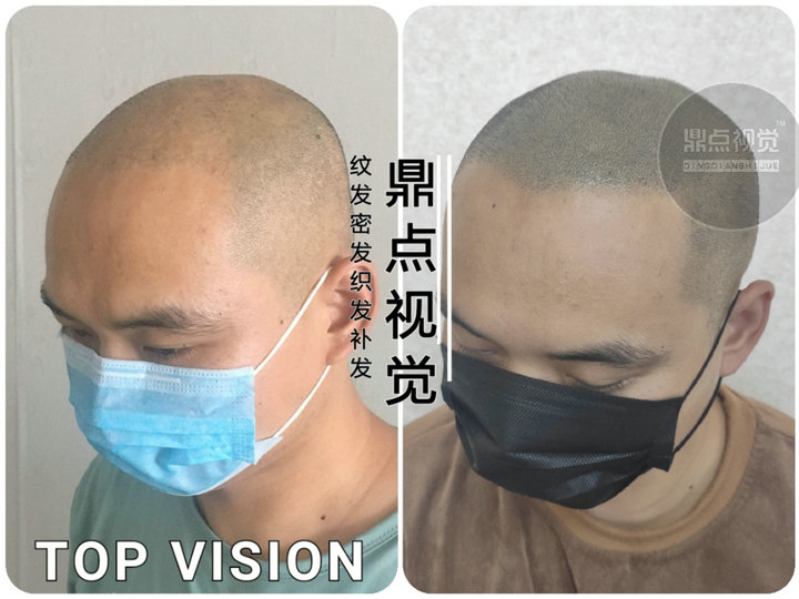 滴滴司机选择北京鼎点纹发经历连载2补出发际线一切变坦然