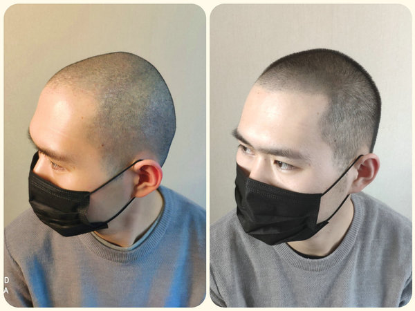 甘肃兰州smp3d纹发定制调整男士个人专属发际线